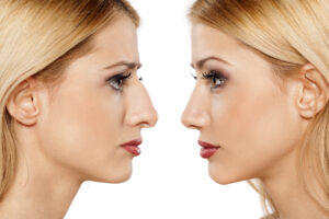 Why is Turkey Best for Nose Job?