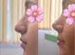 What is the Success Rate of Rhinoplasty?