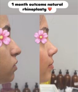 What is the Success Rate of Rhinoplasty?