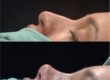 Where Do Celebrities Go for Rhinoplasty?
