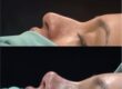 What is the Most Requested Nose Job?