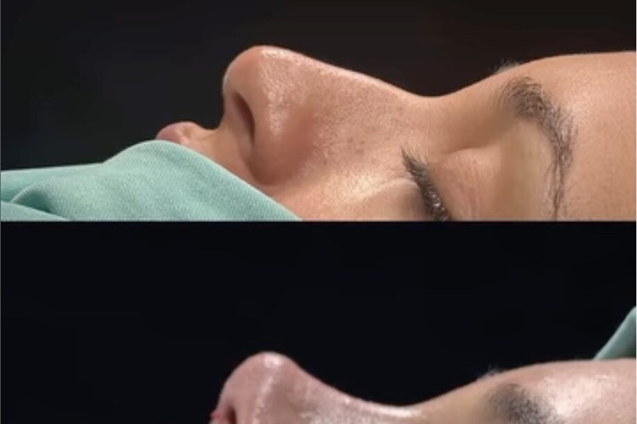 What is the Most Requested Nose Job? What is the Most Requested Nose Job?