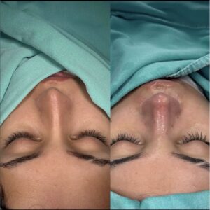 What is the Most Requested Nose Job?