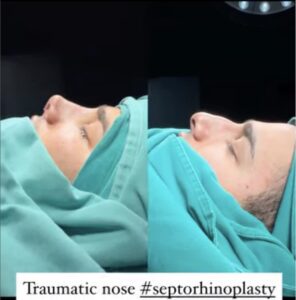 Where Do Celebrities Go for Rhinoplasty?