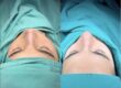 Is a Nose Job in Turkey Worth It?