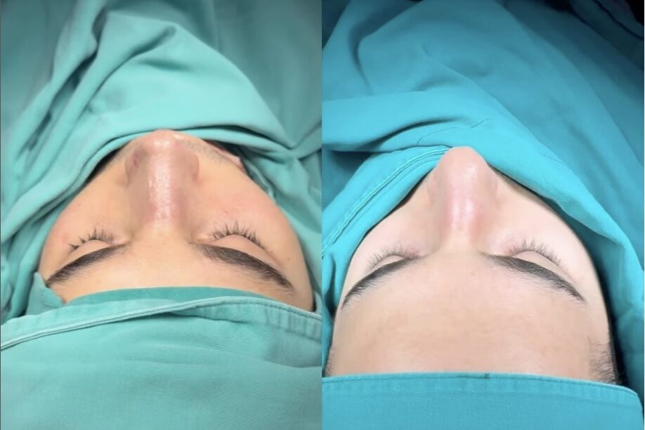 Is a Nose Job in Turkey Worth It? Is a Nose Job in Turkey Worth It?