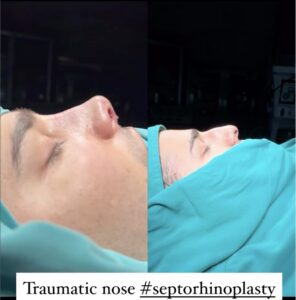 What is Ethnic Rhinoplasty?