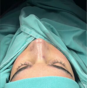 How much is a nose job in Turkey CAD?