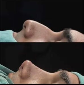 Is a Nose Job in Turkey Worth It?