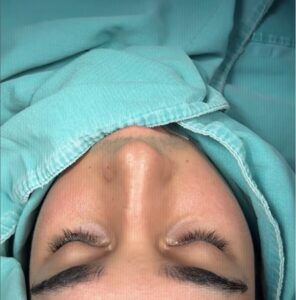 Which country has the best nose job surgeons?