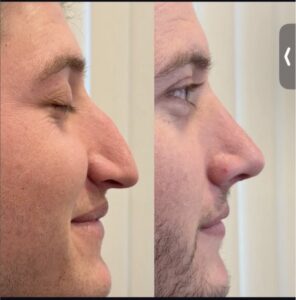 How old do you have to be to get a rhinoplasty in Turkey?