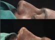 What is Ethnic Rhinoplasty?