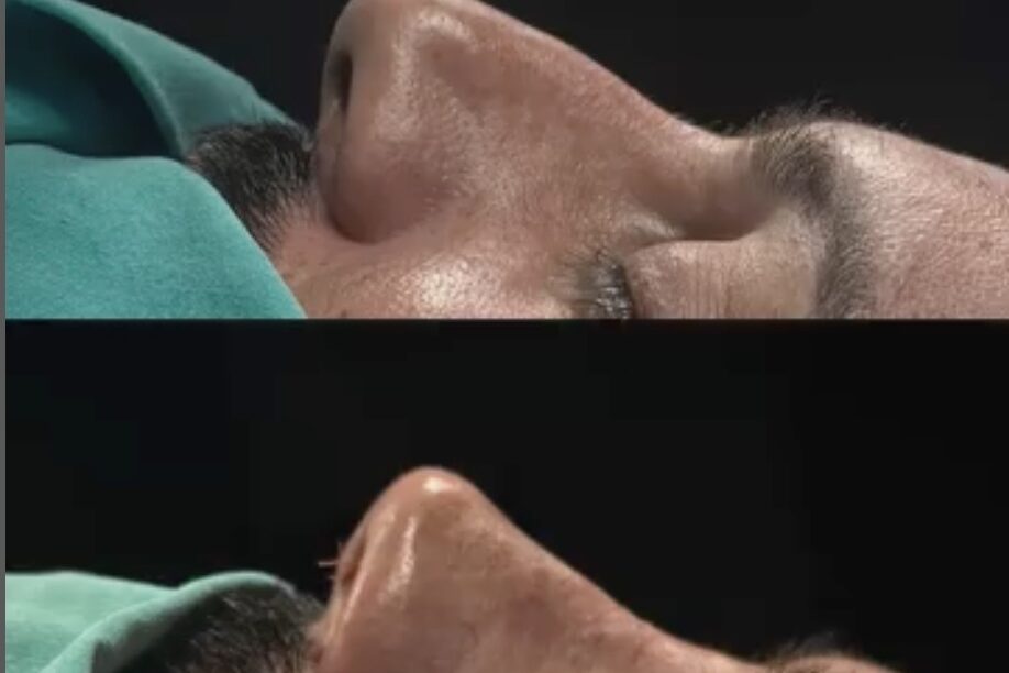 What is Ethnic Rhinoplasty?