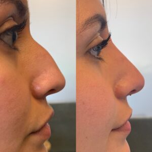 How much to save for a nose job in Turkey?