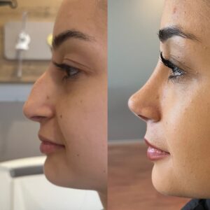 Who Gets the Most Nose Jobs?