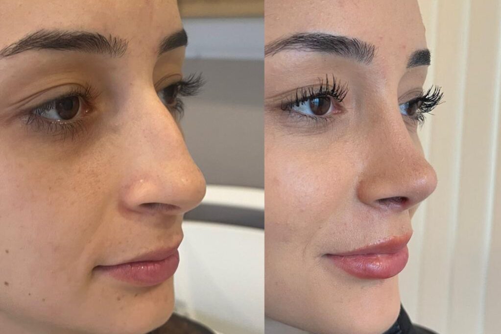 Who Gets the Most Nose Jobs? Who Gets the Most Nose Jobs?