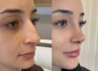 Who Gets the Most Nose Jobs?