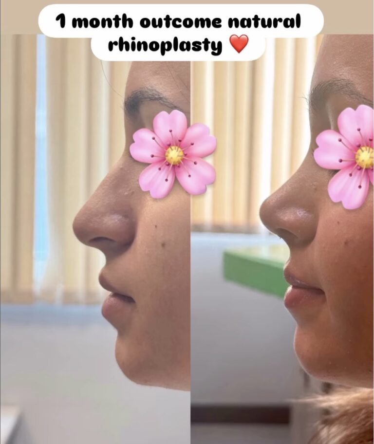 What is the Success Rate of Rhinoplasty?