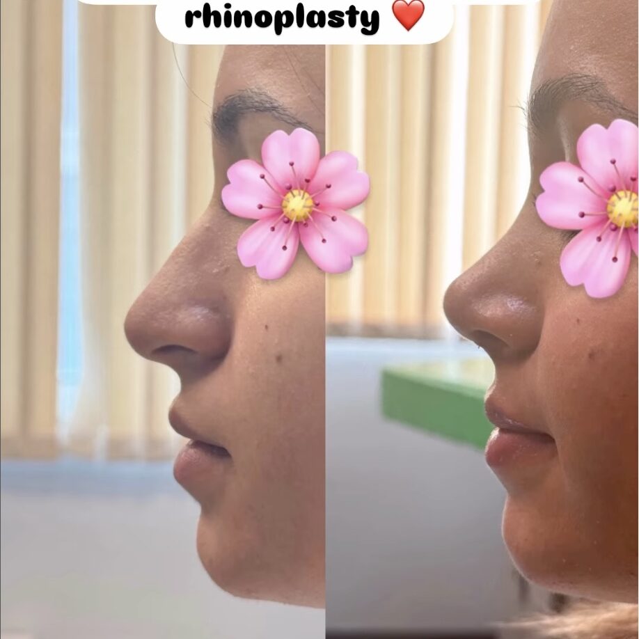 What is the Success Rate of Rhinoplasty?