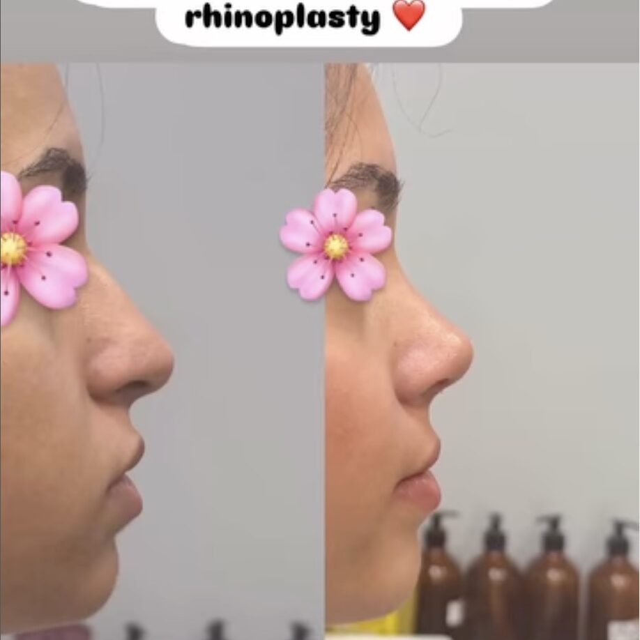 What is the Success Rate of Rhinoplasty?