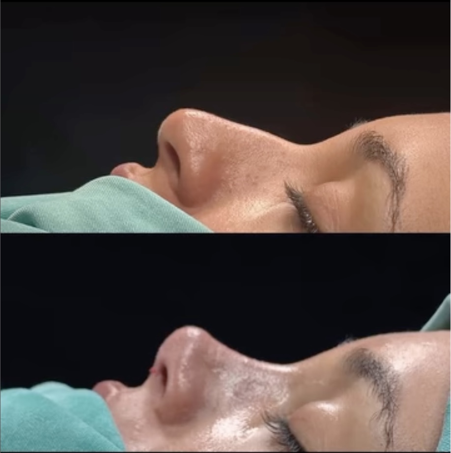 Where Do Celebrities Go for Rhinoplasty? Where Do Celebrities Go for Rhinoplasty?