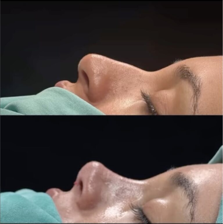 What is the Most Requested Nose Job?