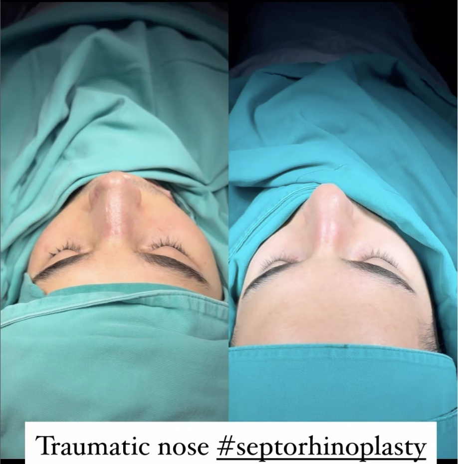 Is a Nose Job in Turkey Worth It? Is a Nose Job in Turkey Worth It?