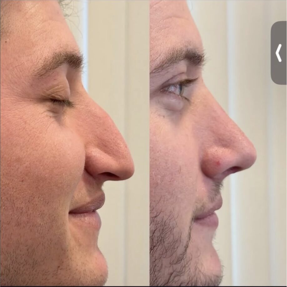 How old do you have to be to get a rhinoplasty in Turkey?