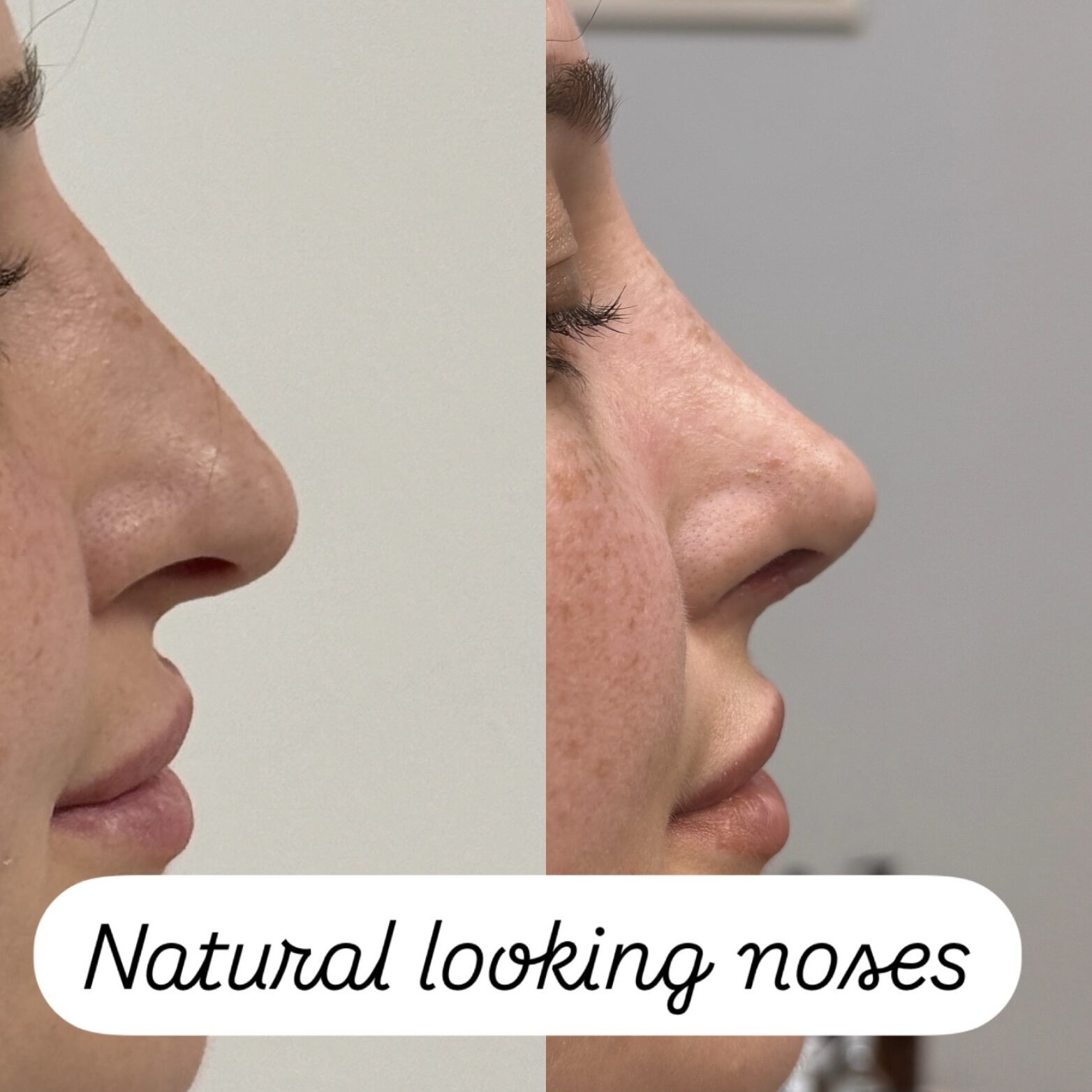 How old do you have to be to get a rhinoplasty in Turkey?