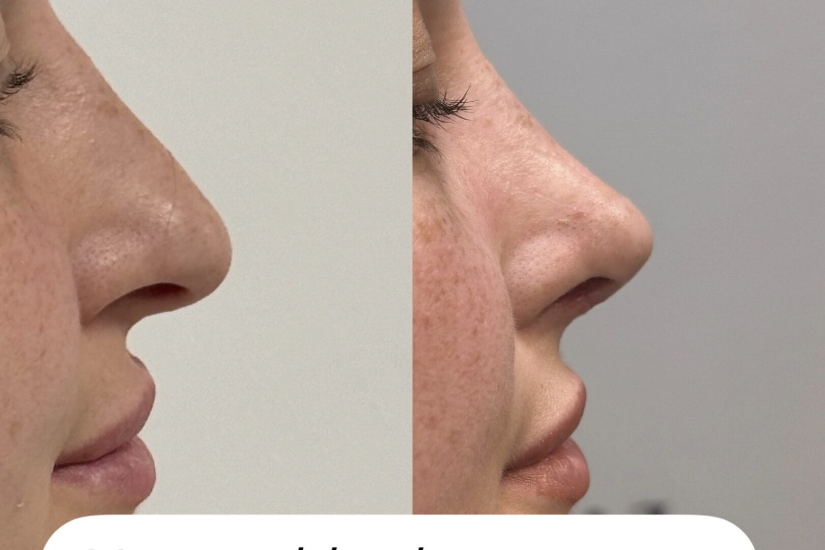 How old do you have to be to get a rhinoplasty in Turkey? How old do you have to be to get a rhinoplasty in Turkey?