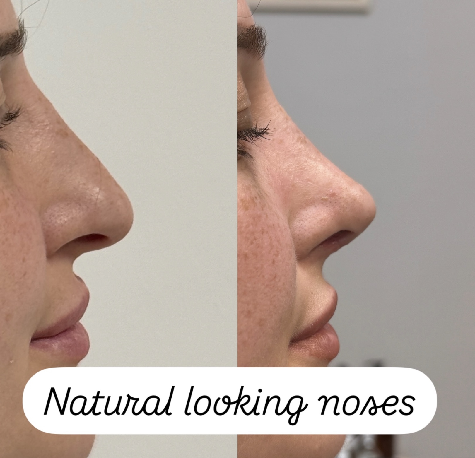 How old do you have to be to get a rhinoplasty in Turkey? How old do you have to be to get a rhinoplasty in Turkey?