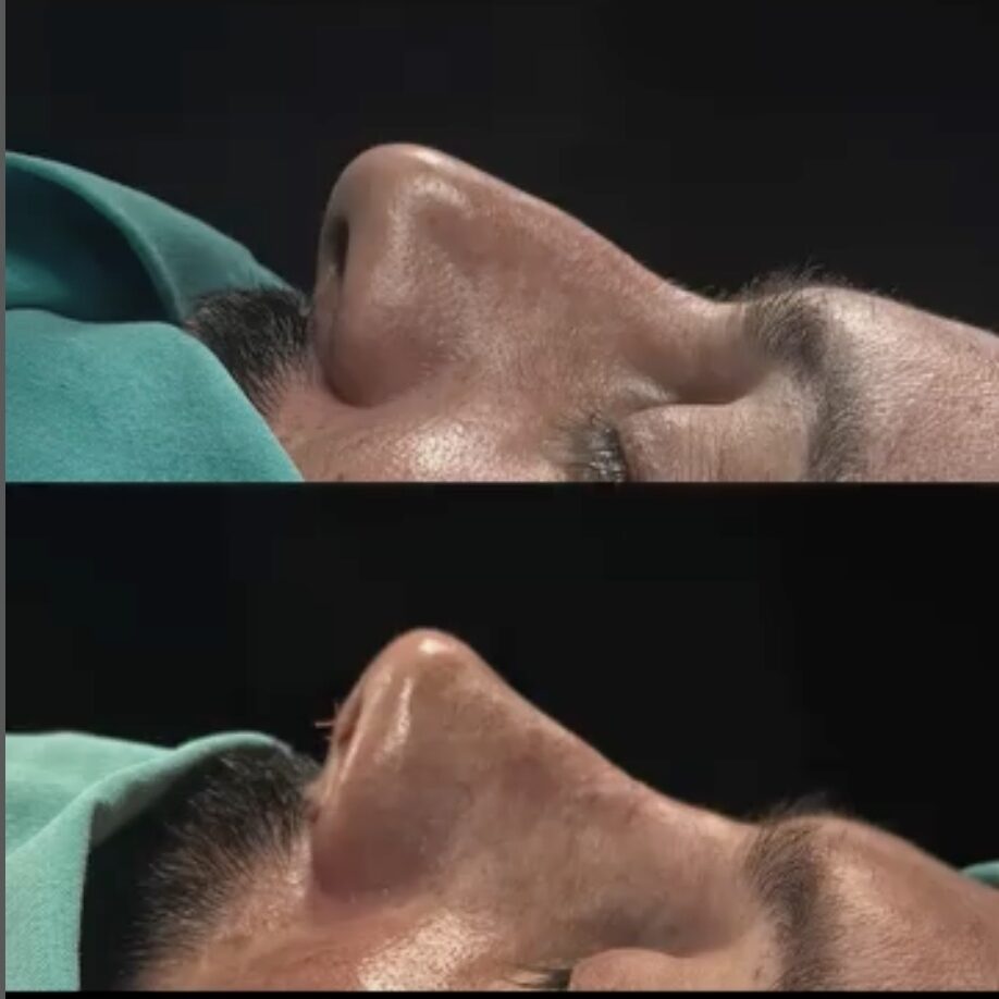 What is Ethnic Rhinoplasty?