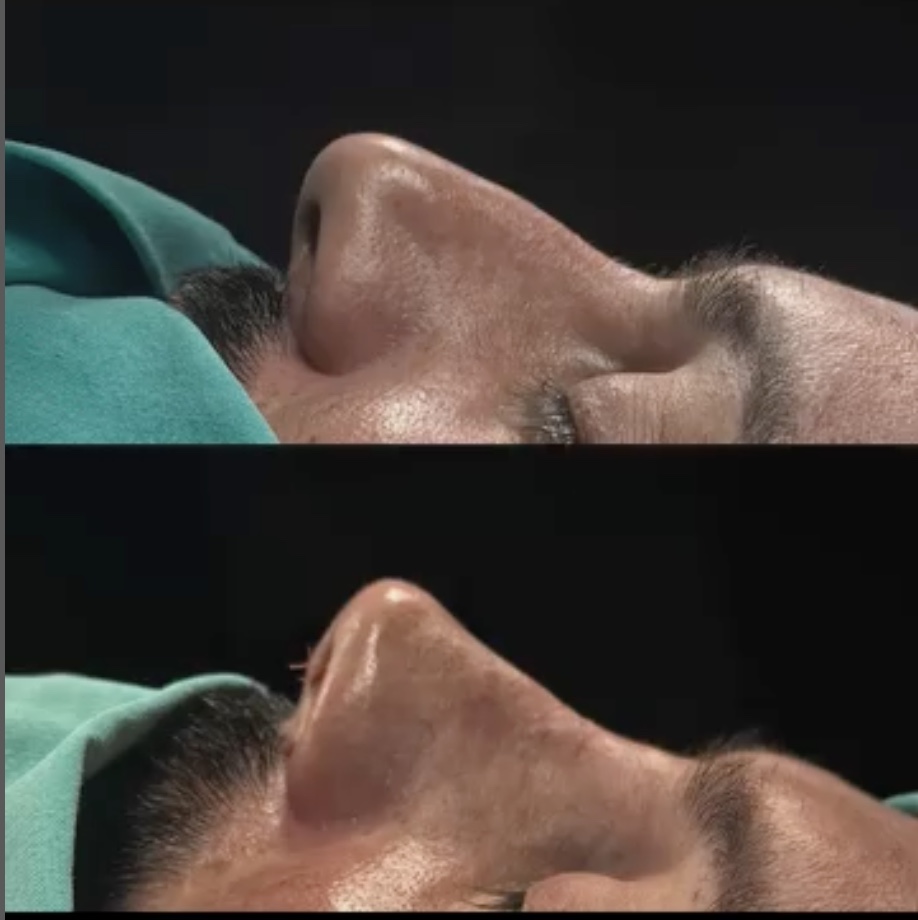 What is Ethnic Rhinoplasty? What is Ethnic Rhinoplasty?