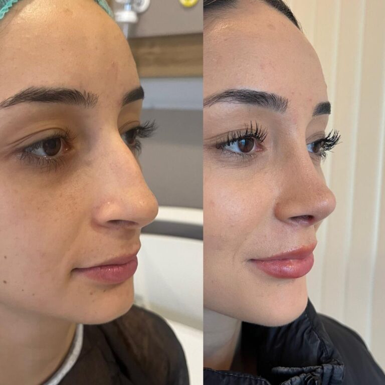 Who Gets the Most Nose Jobs?